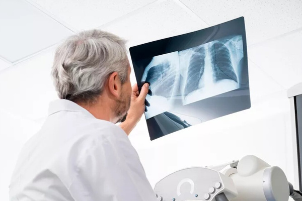 Мультиспиральная компьютерная томография лёгких: паттерны интерстициальных заболеваний, тактика при выявлении очагов (LUNG-RADS).